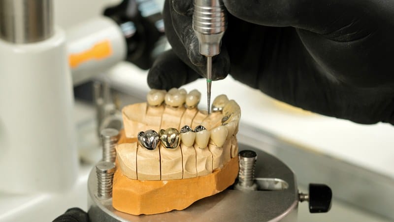 Gloved dental technician refining porcelain-fused-to-metal crowns and a bridge on a stone model with a handpiece